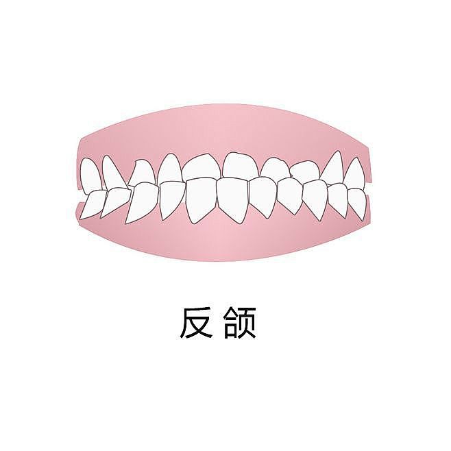 2、反颌