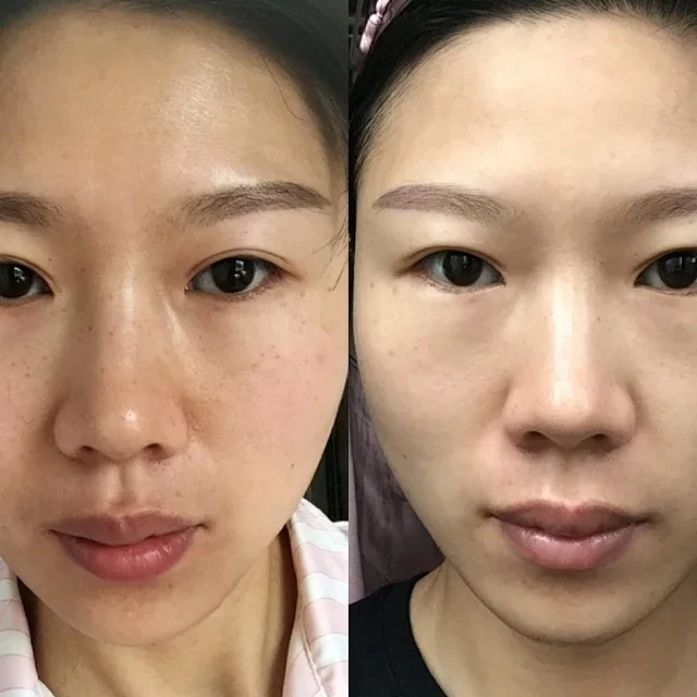 医美案例对比图 - 小红书搜索