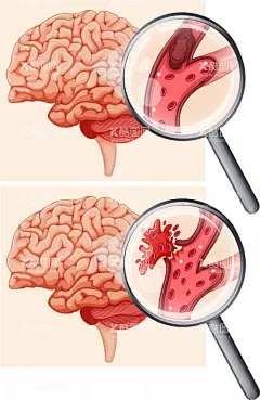 脑卒中  - 源文件下载【酷图网】类型,大脑,预防中风日,预防中风,世界中风日,脑中风展板,脑血管,525,老年保健,热中风,中风宣传栏,世界预防中风,脑卒中,卒中,小中风,医院宣教,医疗,折页,世界卒中日,脑卒中日,脑中风,中风,主题,展板,海报,素材,元素,预防疾病,知识科普,脑卒中海报,健康教育,卒中日展板,防治,矢量