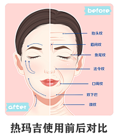 芒果会过敏采集到脸部除皱收集