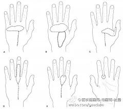 远端蒂虎口背侧皮瓣 The distally-based dorsal hand flap 【论文医学插画欣赏】国内外文献全文可以为您免费传递！QQ 18147895 活动详情见 O网页链接 ★★★ 喜欢 医学插画 医学美图 医学插图 医学美术 医学可视化 医学插画师 医学动画 请关注我。★★★请前往高能区域 O网页链接 ​​​​