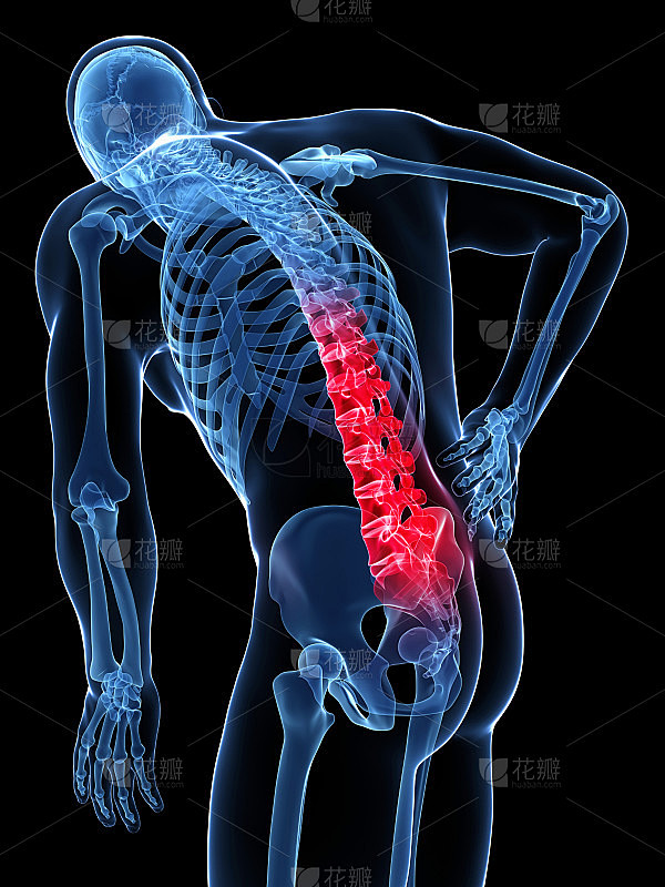 一个患有急性下脊柱疼痛的男人的3d渲染模...