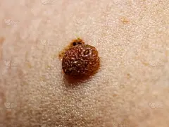 特写皮肤上的棕色痣。