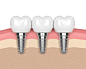 牙齿植入物在牙龈中的3d呈现器图片素材-图片ID：312424929