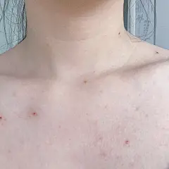 被洗浴传染了水瘊子 传染性软疣 - 小红书