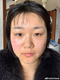 #女性激光祛斑案例分享#
来自小姐姐激光祛斑后的效果分享，希望能给你带来一些参考帮助
【色斑类型】：遗传性雀斑
【治疗方式】：光子嫩肤
【效果反馈】：十七天的时候结痂都掉完了，脸上也比之前看起来干净了很多
【博主寄语】：小姐姐的雀斑不是很严重，一次治疗的效果就很好，平时也要做好防晒工作 ​​​​...展开全文c