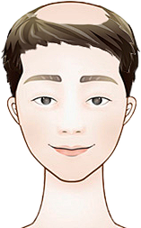Hero喵采集到植发脱发