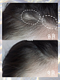 【晒体验】茂密长发不怕掉 : 新专栏【晒体验】又来惹❗️❗️ ✨✨✨✨✨✨✨✨✨ 以下来自小红薯 @碳酸噜噜 丰添抑制落发安瓶精华实测 #女士抑制落发安瓶精华液 100ml ☁️曾经的我也拥有着一头茂密长发 前段时间开始不停的掉发