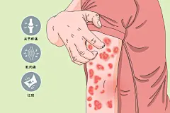 狼疮样综合征