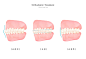 矫正过程 可视模型 牙齿整形 健齿插图插画设计PSD tid273t000515