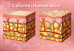 diagram-showing-cellulite-human-skin_1308-43333.jpg (1060×741)