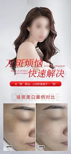 美业祛斑祛痘案例海报-源文件分享-ywjfx.cn