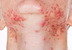 淋巴腮边痘的搜索结果_360图片