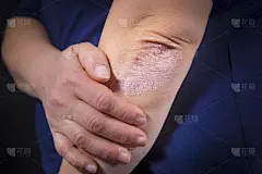 牛皮廯,肘,湿疹,皮肤状况,皮炎,干的,皮肤病学,痛苦