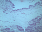 畸胎瘤 显微切片图片