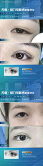源文件下载【医美案例双眼皮海报】编号：20231123110556609