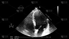 经食管超声检查心脏图像。