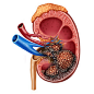 人体肾癌解剖医学概念