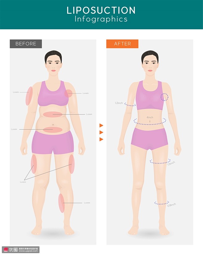 吸脂减肥 图例示范 脂肪抽吸 整形插图插...