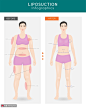 吸脂减肥 图例示范 脂肪抽吸 整形插图插画AI11医疗保健素材下载-优图网-UPPSD