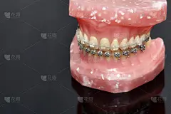金属,牙齿,人,模型,牙齿矫正器,人的嘴,有线的,牙印,闭塞,支柱