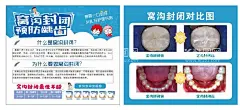 窝沟封闭  - 源文件下载【酷图网】窝沟封闭,牙科,牙医,蛀牙,保护牙齿,牙科海报,