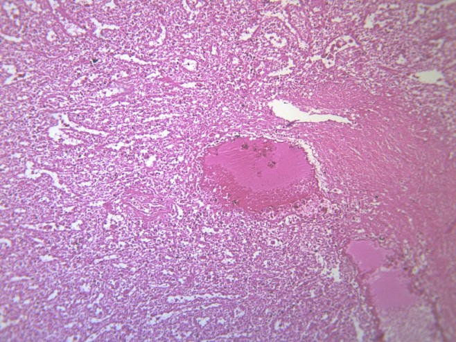 脾被膜玻璃样变显微切片图片