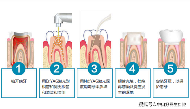 一念之差,她的根管治疗白做了