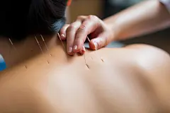 医学医疗中医养生针灸摄影图片