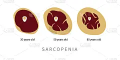 Sarcopenia老年。肌肉组织置换