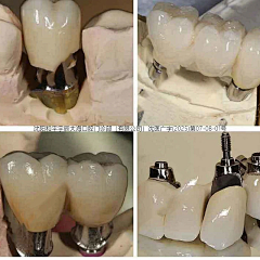 善逸1107采集到口腔种植牙拼图四宫格九宫格信息流