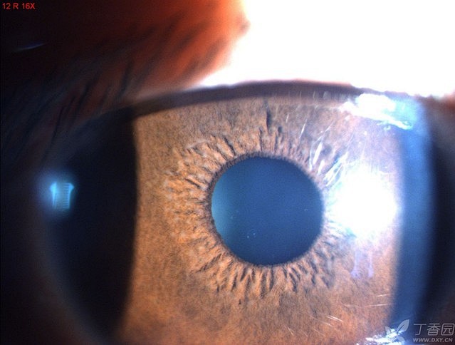 fuchs综合征1虹膜脱色素萎缩