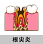 6根尖炎