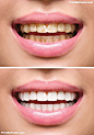 女人牙齿美白前后的海报。 幸福微笑的女人。 牙齿健康概念。 口腔护理，牙科海报，#海报，#printmeposter，#mousepad，#tshirt