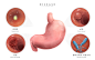 医院内窥镜胃溃疡胃癌幽门螺旋杆菌研究医学疾病器官插画素材 :  