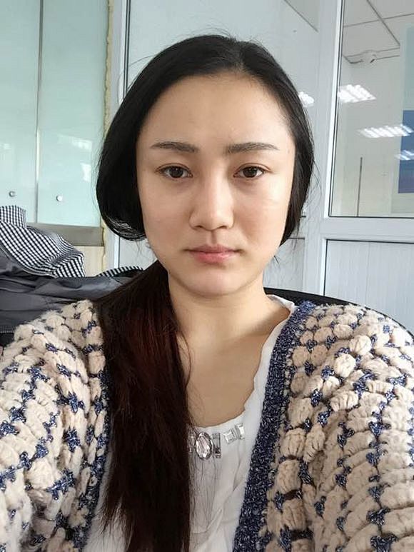 【图片】我的瘦脸前后对比照【瘦脸针吧】_...