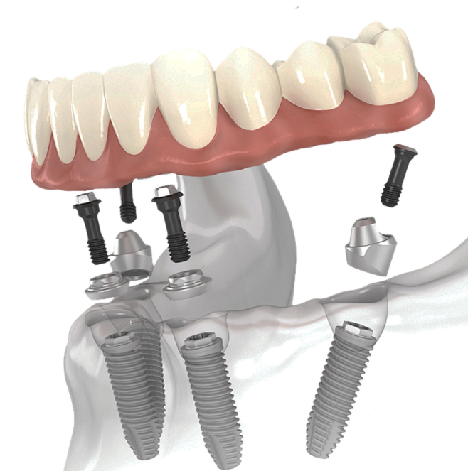 all-on-4 implants