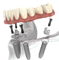 all-on-4 implants
