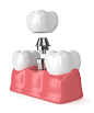 3d渲染的牙齿与种植牙图片素材-图片ID：312639210