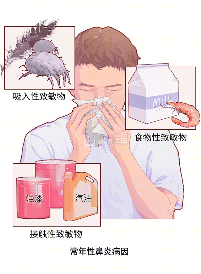 常年性鼻炎配图