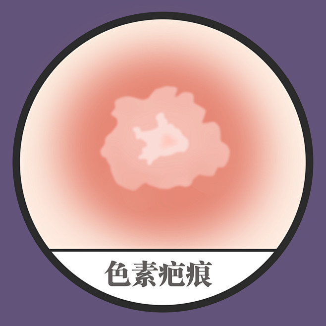 疤痕 疤痕消除 疤痕体质 疤痕增生如何消...