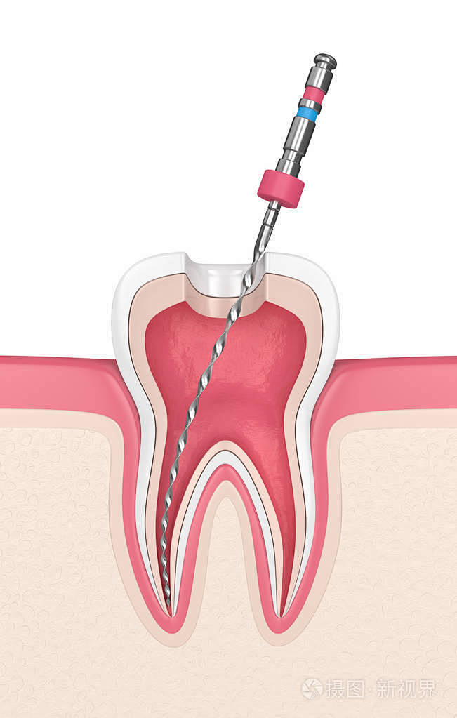 牙床内牙锉的三维渲染。 根管治疗的概念。