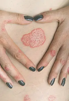 牛皮癣图片下载