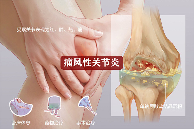 痛风性关节炎贴什么膏药