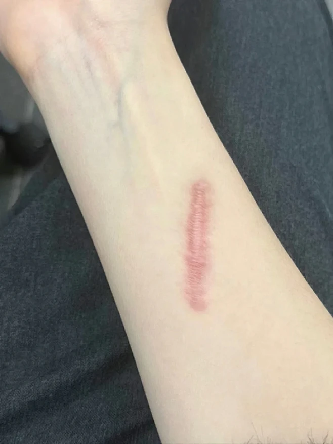 整破防了 疤痕增生的痛苦谁能懂？