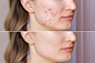 Cropped shot of a young woman's face before and after acne  treatment on face.z Premium Photo