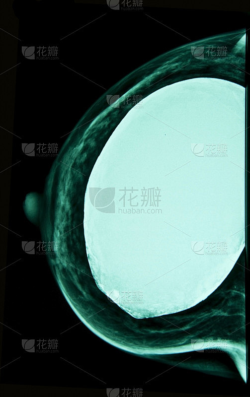 乳房硅胶植入物，x光片