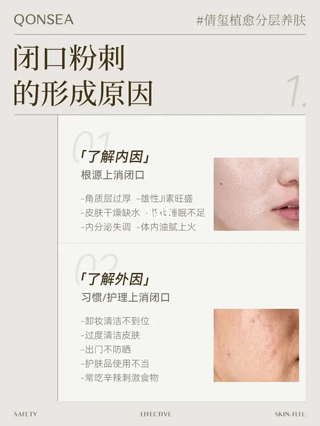 护肤知识｜如何正确去闭口？如何正确预防