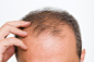 baldness - Google 搜索