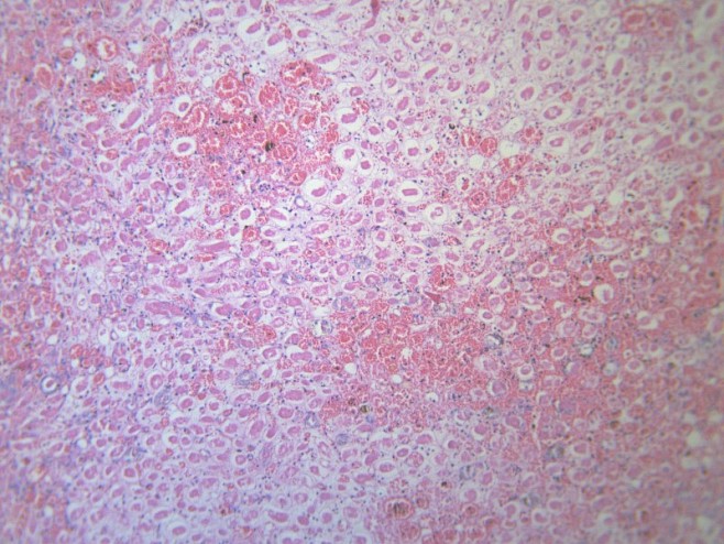 肾凝固性坏死显微切片图片